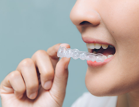 clear-fix-braces-fulham-dental-centre