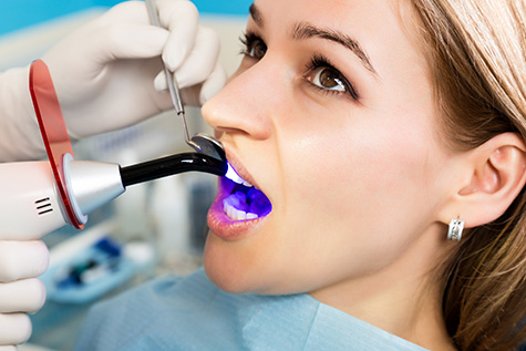 composite-bonding-benefits-fulham-dental-centre