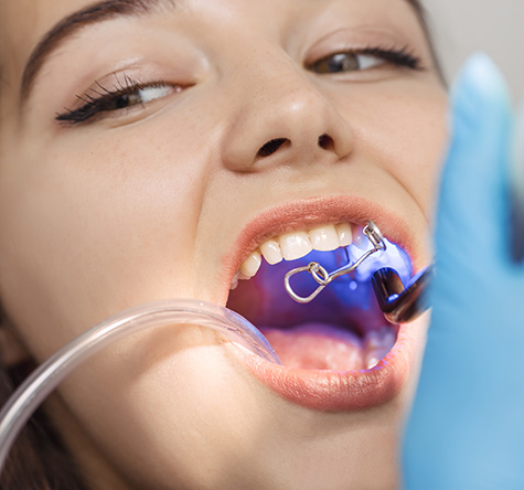 composite-bonding-procedure-fulham-dental-centre