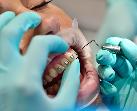 lingual-braces-fulham-dental-centre